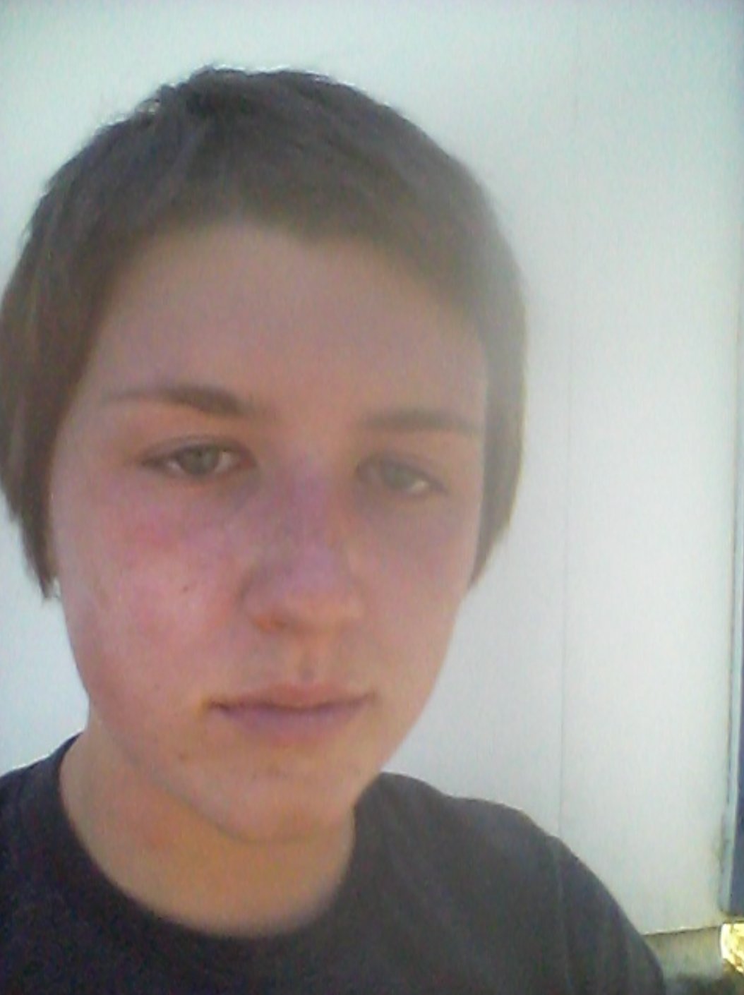 Poison oak rash on face